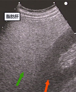 脂肪肝