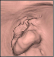 大腸ＣＴ画像（病変部位）　