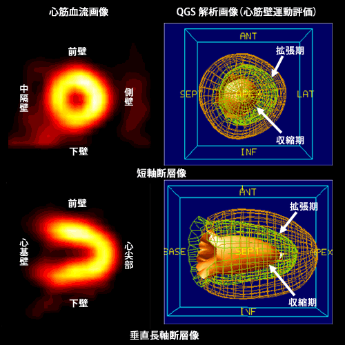 心筋血流シンチによって得られる画像