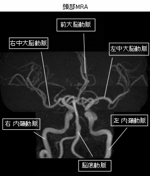 頭部MRA