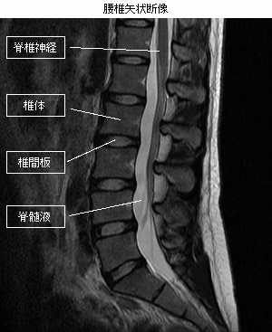 腰椎矢状断像