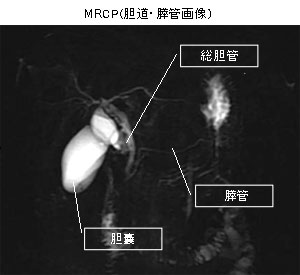 MRCP(胆道・膵管画像)