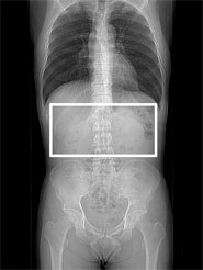 MRCP(胆道・膵管画像)