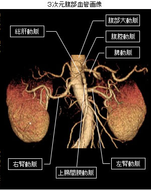 ３次元腹部血管画像
