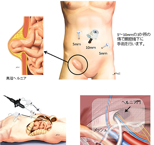 腹腔鏡下鼠径ヘルニア修復術(TAPP法)