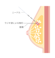 乳がんに対する経皮的ラジオ波焼灼療法【画像提供：コヴィディエンジャパン株式会社】