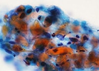 喀痰中に出現した肺癌(扁平上皮癌)細胞