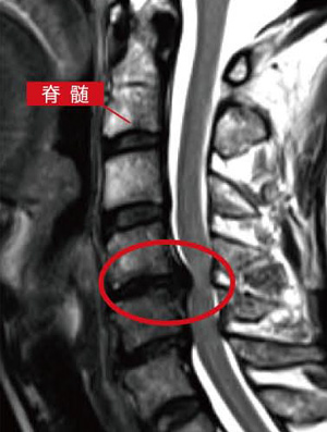 すべり 症 頚椎