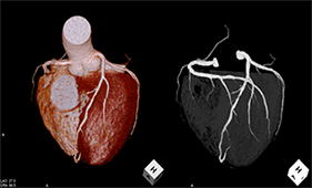 冠動脈（心臓）