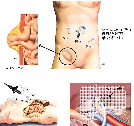 腹腔鏡下鼠径ヘルニア修復術（TAPP法）